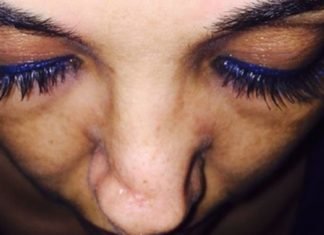 Le amputan parte de la nariz en cirugía estética