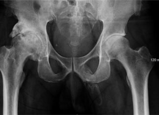 A este hombre el pene se le está convirtiendo en un hueso